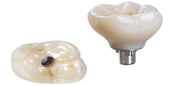 Zirconia Screw-Retained Implant crown